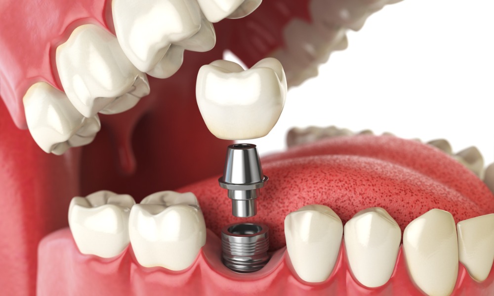 5) Impressive Celebrity Dental Implant Jobs that Look Great!