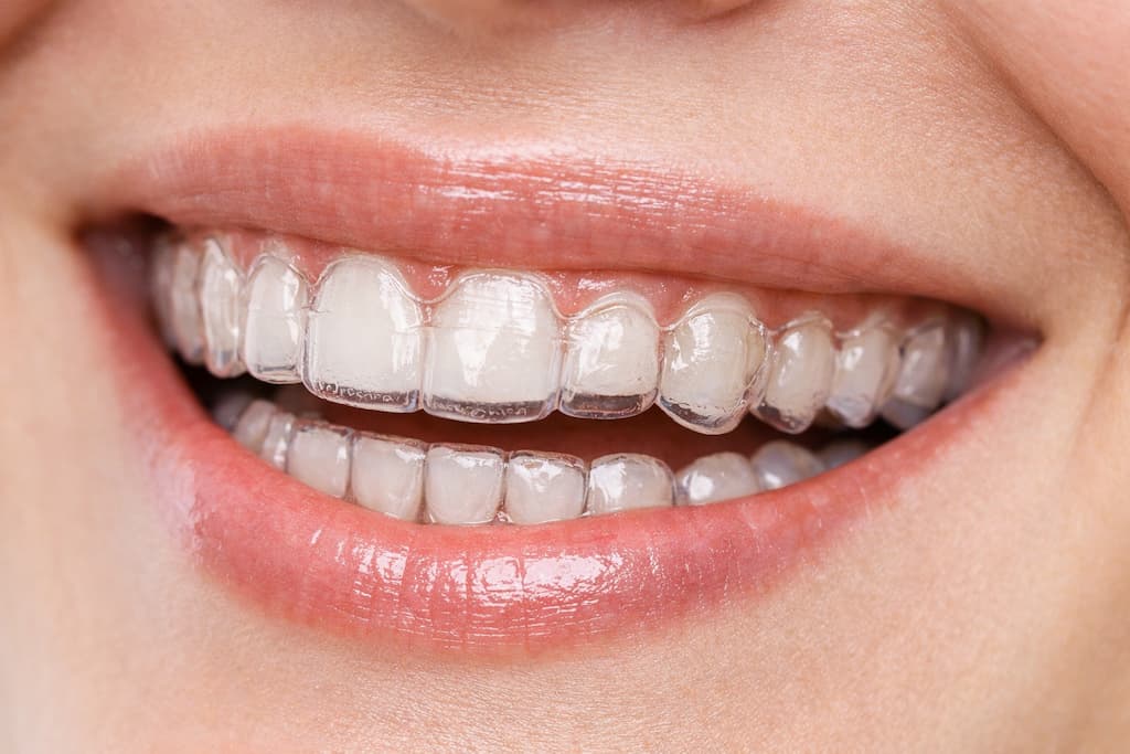A close-up image of a smiling woman wearing Invisalign.
