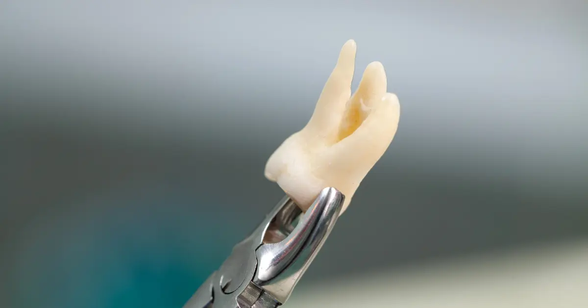 A close-up of a freshly extracted molar tooth with visible roots held in dental extraction forceps against a blurred background