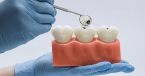 Magnified view of an early cavity on a molar illustrating the first signs of tooth decay.