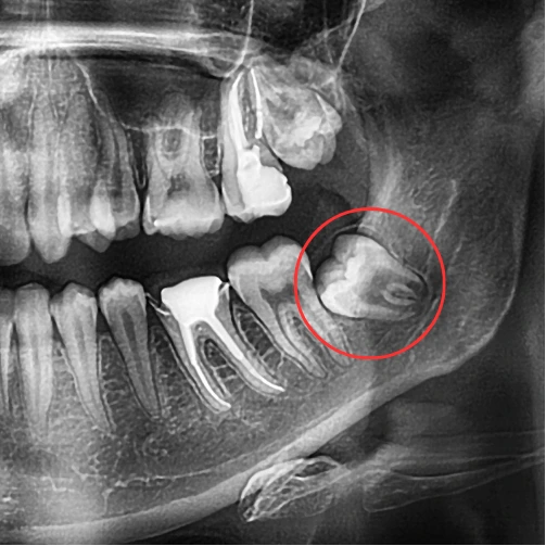 Dental X-ray showing impacted wisdom teeth, including a horizontally impacted lower third molar that may require wisdom teeth removal.