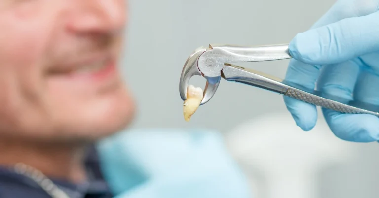 Dentist holding an extracted wisdom tooth with dental forceps following a wisdom teeth removal procedure.