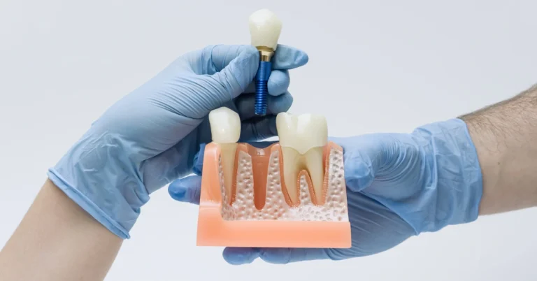 Dentist wearing blue gloves holding a dental implant with a titanium screw and artificial tooth above a jawbone model, demonstrating how dental implants replace missing teeth.